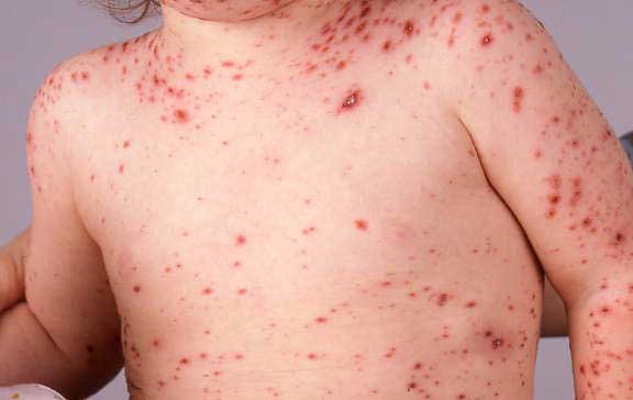 Se está vacunando gratis contra la varicela