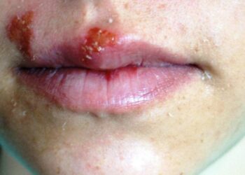 Virus del papiloma humano: crean la Sala de Espera Activa