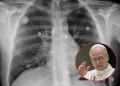 El Papa León XIV será operado: ¿puede venir a la Argentina?