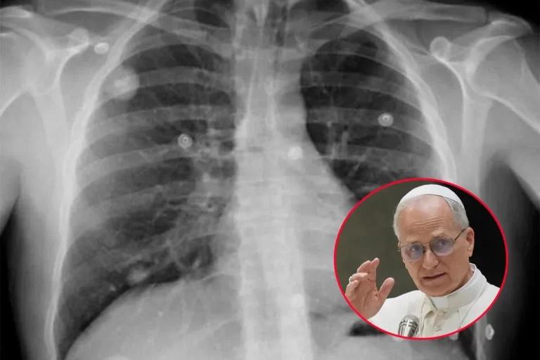 El Papa León XIV será operado: ¿puede venir a la Argentina?